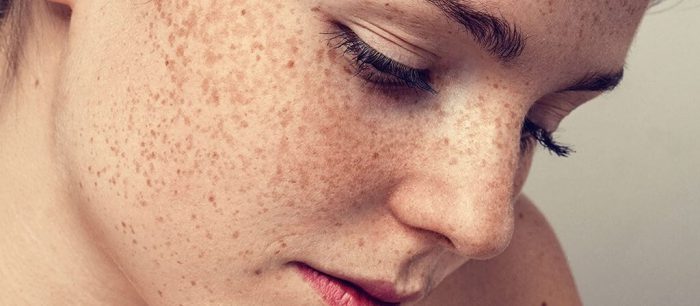 درمان سریع لک های پوستی با کمک ماسک صورت 